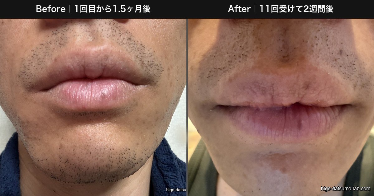 ヒゲ脱毛1回目から1.5ヶ月後と11回受けて2週間後のBefore→After比較